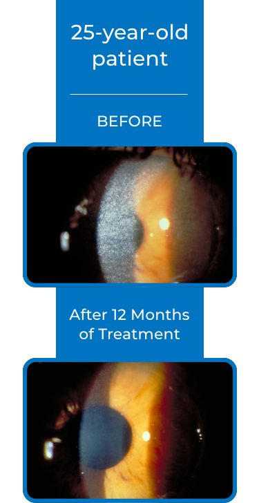 eye cystinosis patients' corneas before and after treatment
